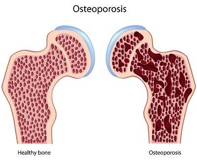 Como prevenir la osteoporosis