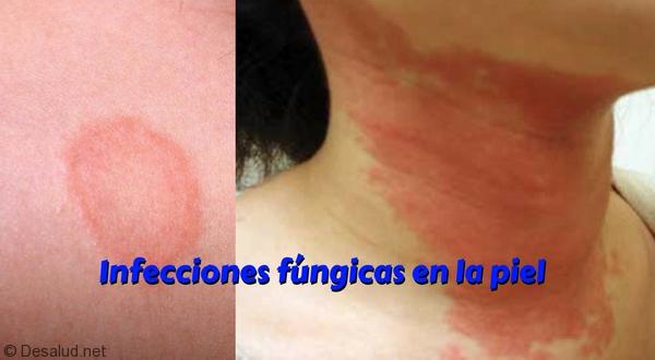Infecciones fúngicas en la piel